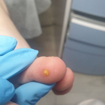 Удаление бородавки