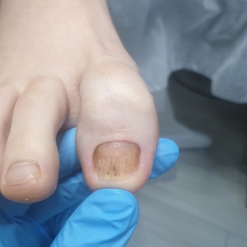 Обработка микоза