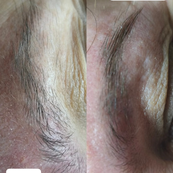 електроепіляціяжитомир