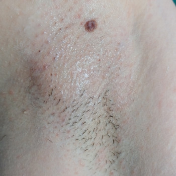 Електроепіляція -пахви