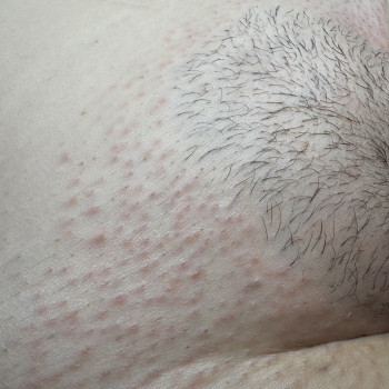 Зона бікіні-лобок