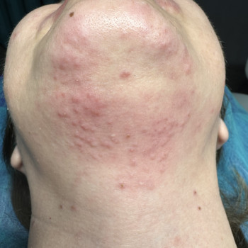 Електро-підборіддя,шия