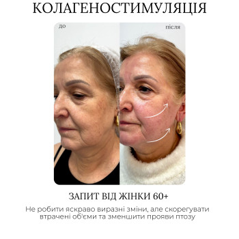 Колагеностимуляція препаратом полімолочної кислоти