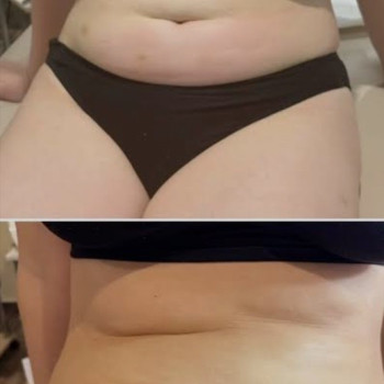 Струнке обличчя(про ліполітики)🧚🏻‍♀ ⠀ Ліполітики – це біологічно активний матеріал, який сприяє спалюванню жиру, у тому числі підшкірного. Процес розпаду жирів призводить до утворення кислот, які виводяться з організму природним чином. ⠀ Ці засоби є одним з різновидів мезоін'єкцій, що вводяться під шкіру за допомогою найтонших голок і не викликають травм. Сьогодні виділяють два основні види ліполітиків: 🔴Прямі. Найпотужніші речовини, що складаються із двох активних речовин. Їхня дія спрямов