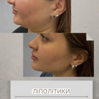 Струнке обличчя(про ліполітики)🧚🏻‍♀ ⠀ Ліполітики – це біологічно активний матеріал, який сприяє спалюванню жиру, у тому числі підшкірного. Процес розпаду жирів призводить до утворення кислот, які виводяться з організму природним чином. ⠀ Ці засоби є одним з різновидів мезоін'єкцій, що вводяться під шкіру за допомогою найтонших голок і не викликають травм. Сьогодні виділяють два основні види ліполітиків: 🔴Прямі. Найпотужніші речовини, що складаються із двох активних речовин. Їхня дія спрямов