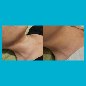 Кольца Венеры до и после первой процедуры