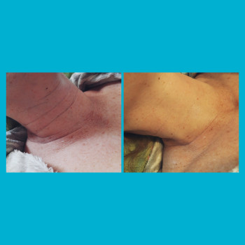 До и после процедуры 50лет