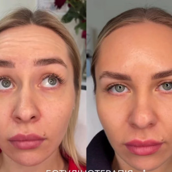 боток лба, позбавлення зморшок, ботулінотерапія