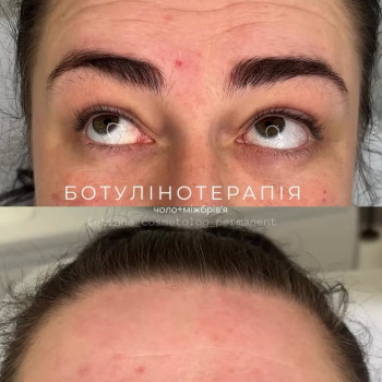 боток лба, позбавлення зморшок, ботулінотерапія