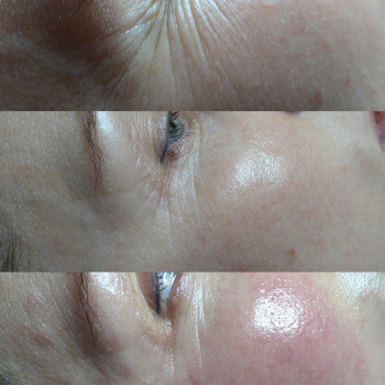 Курс мезотерапії навколо очей