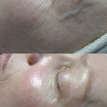 Чистка обличчя