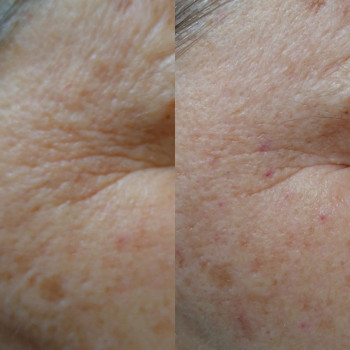 Мезотерапія навколо очей