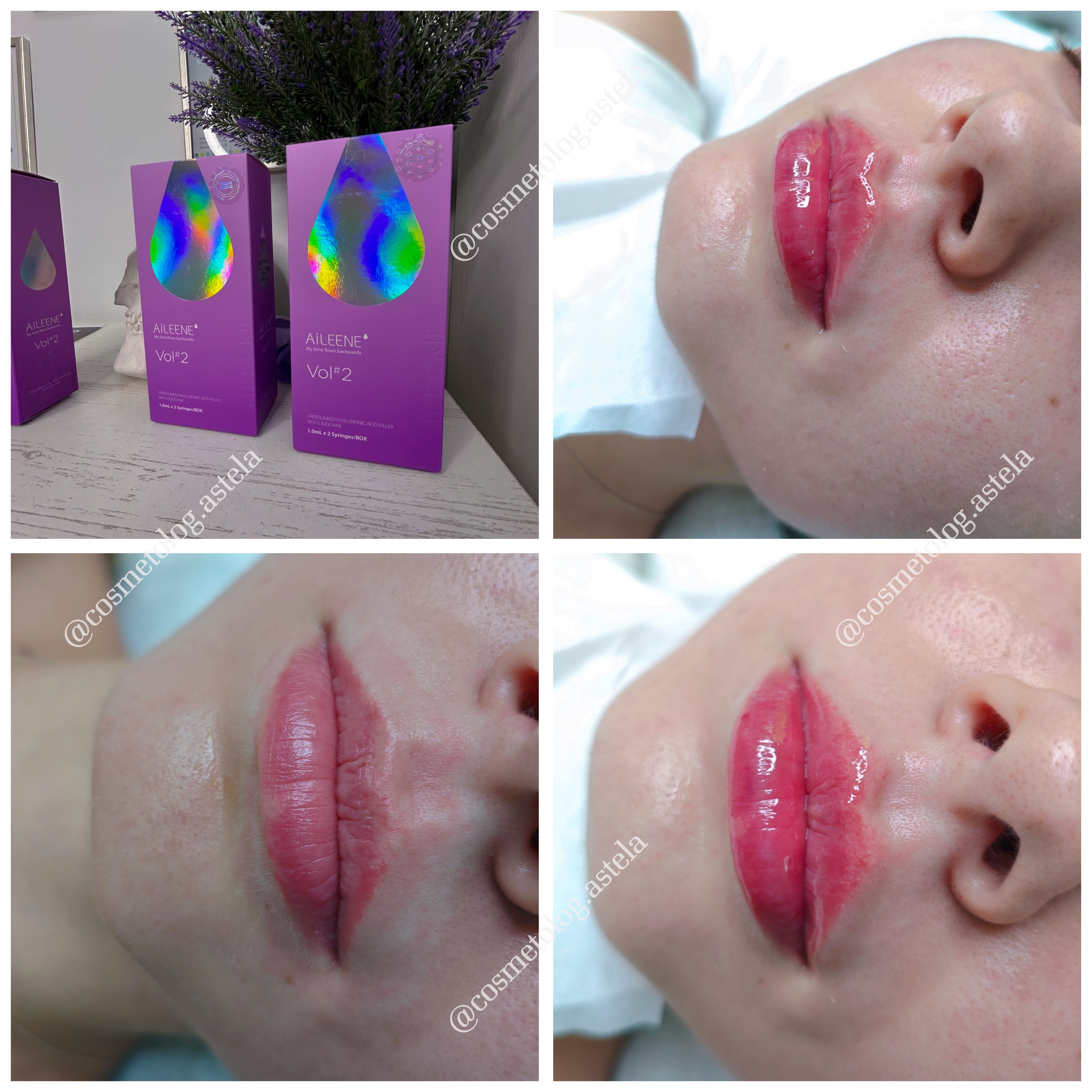 Збільшення губ, фото - Косметолог Анна