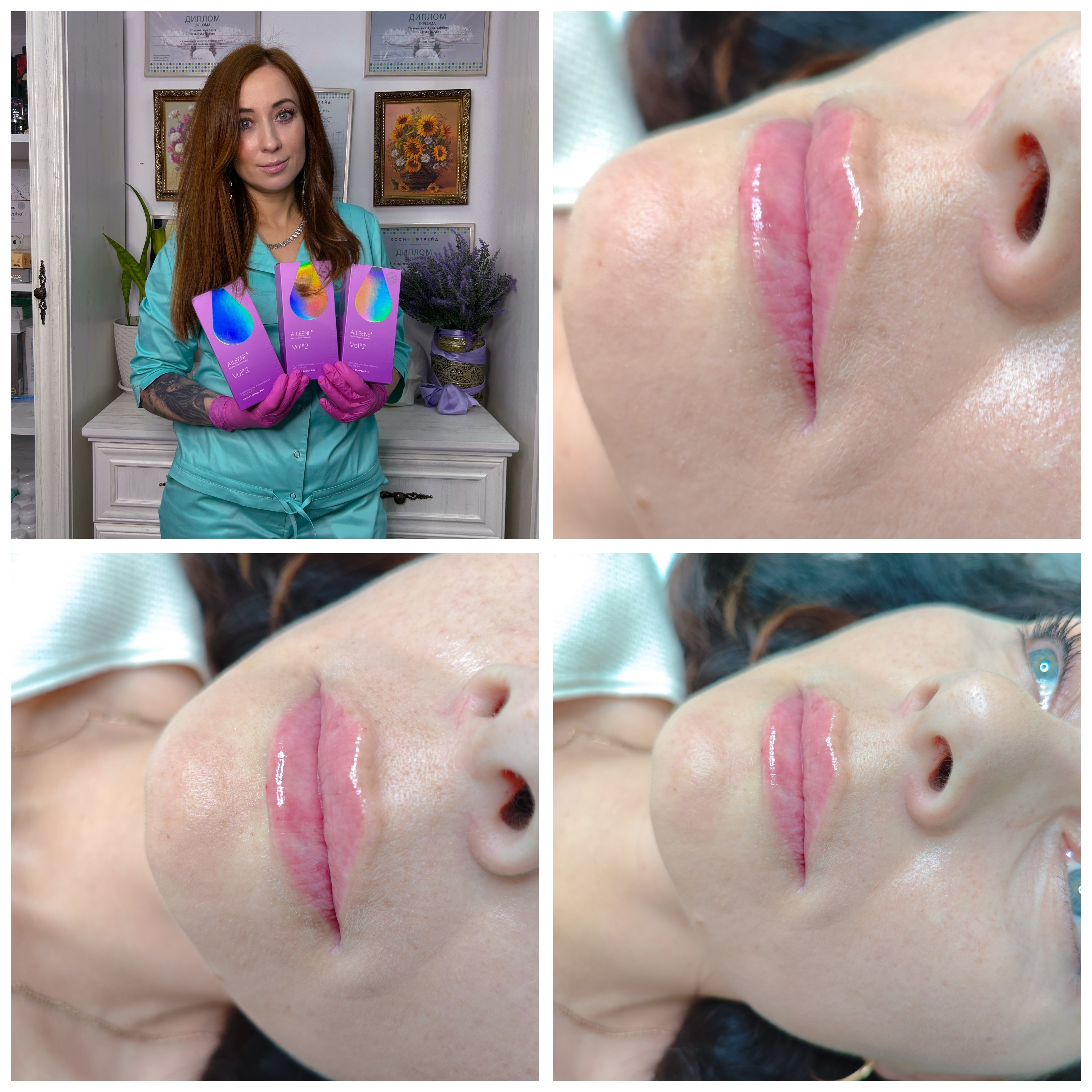 Корекція форми губ, збільшення губ, фото - Косметолог Анна