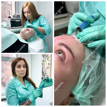 Мезотерапія