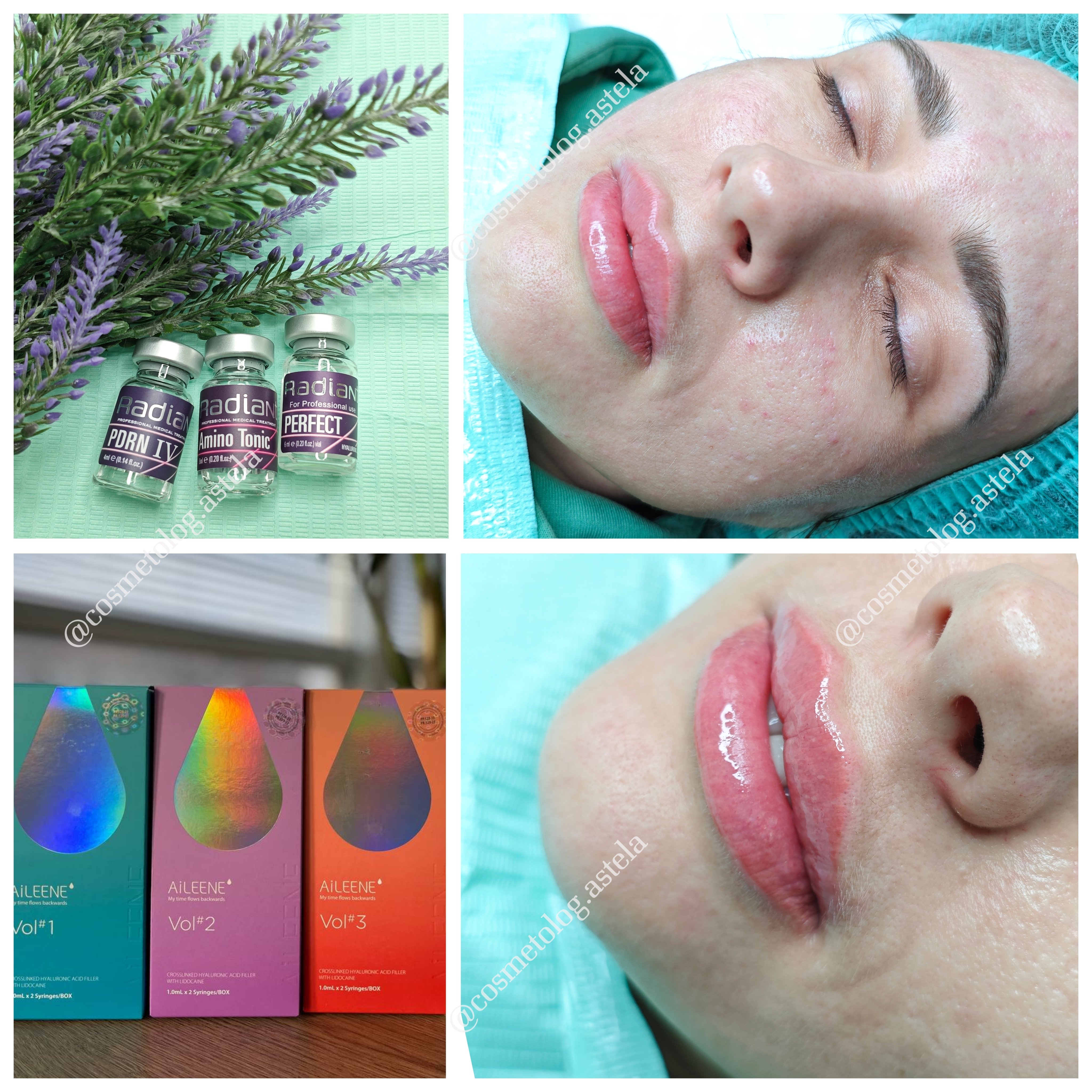 Збільшення губ, фото - Косметолог Анна