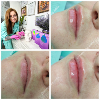 Корекція форми губ, збільшення губ