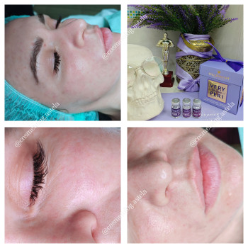 Мезотерапія