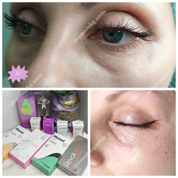 Мезотерапія орбітальної ділянки