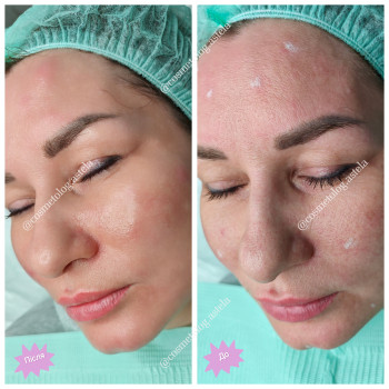 Біоревіталізація