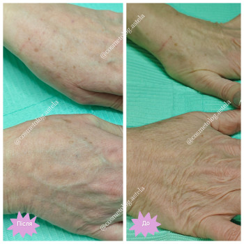 Біоревіталізація рук