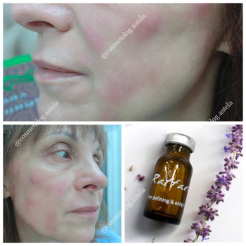 Біоревіталізація Rafaello