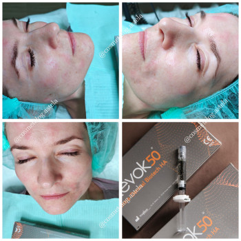 Біорепарація Revok 50