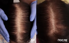 Профілактика випадіння волосся, стимулювання росту волосся Масажист Мария Київ