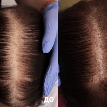 Мезотерапія