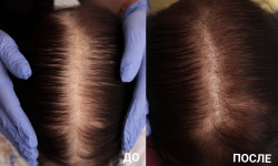 Мезотерапія шкіри голови, стимуляція росту волос Массажист Мария Киев