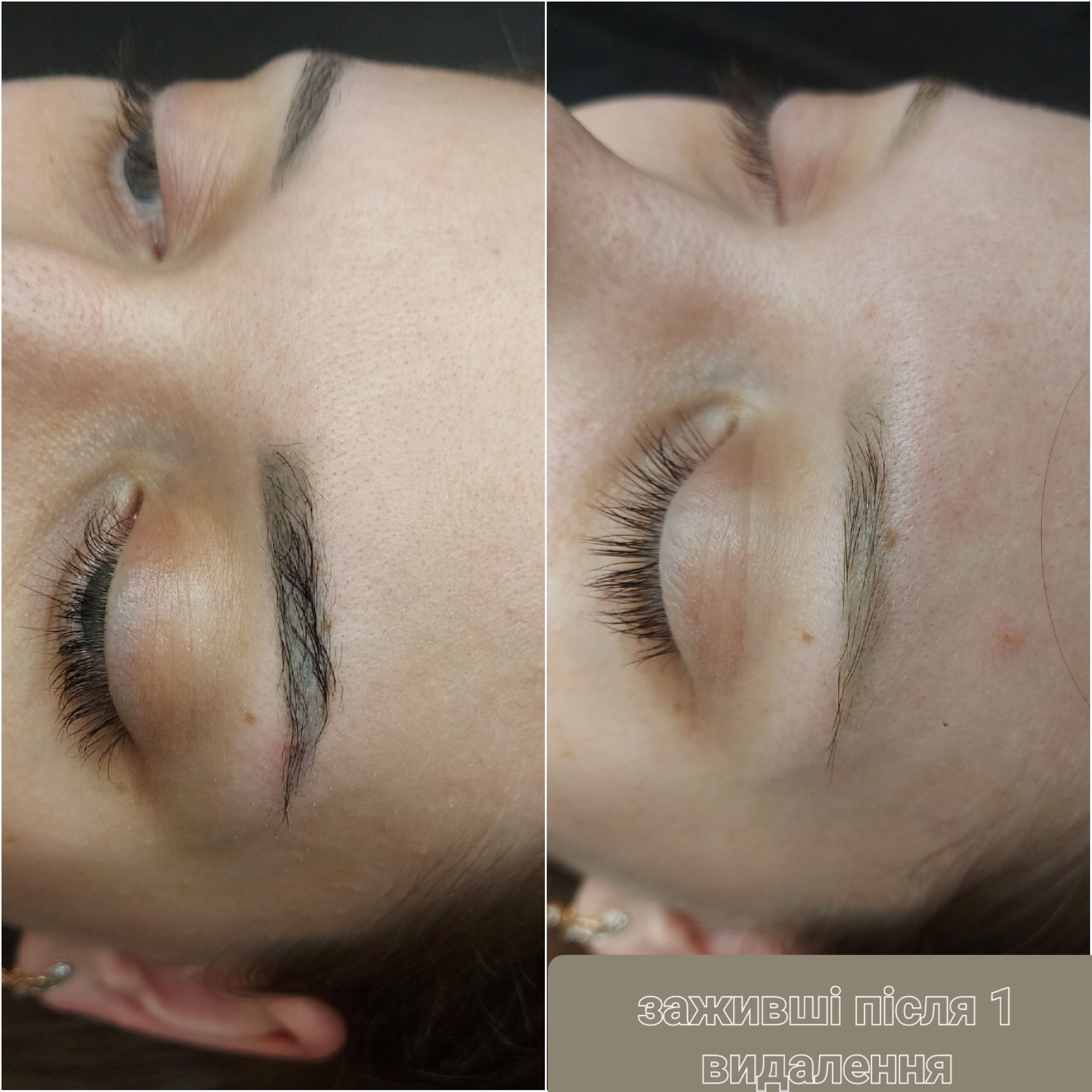Видалення татуажу лазерне ремувером, фото - Майстер татуажу Катерина Андрєєва