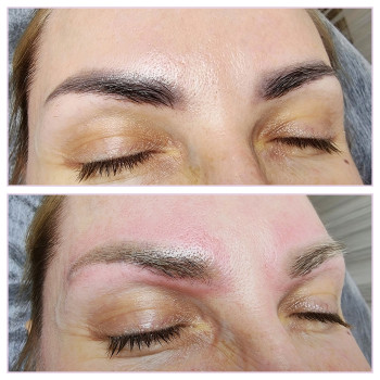 Корекція кольору перманента лазером