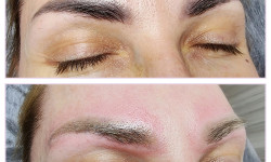 Лазерне видалення татуажу та татуювань Майстер татуажу Катерина Київ