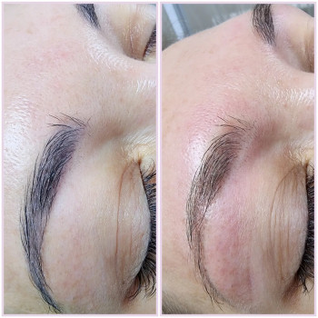 Корекція кольору лазером. Видалення холодного відтінку