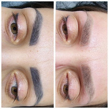 Видалення татуажу. Результат ща одну процедуру