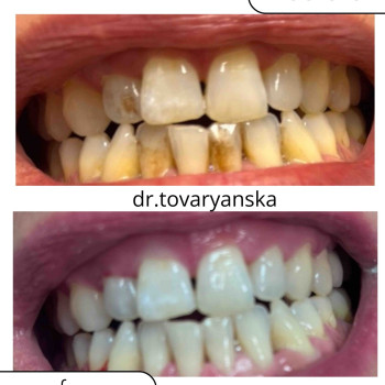 Професійна гігієна зубів