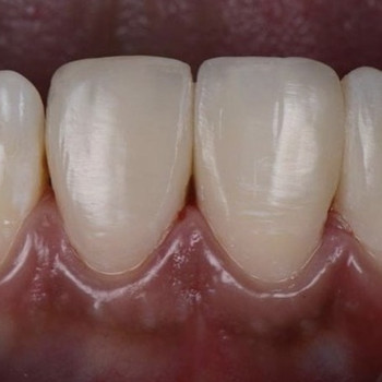 Реставрація зубів