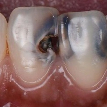 Реставрація зубів