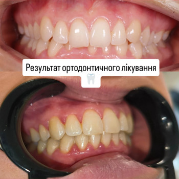 Результат ортодонтичного лікування