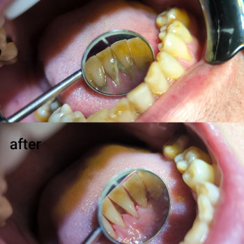 Результат професійної гігієни