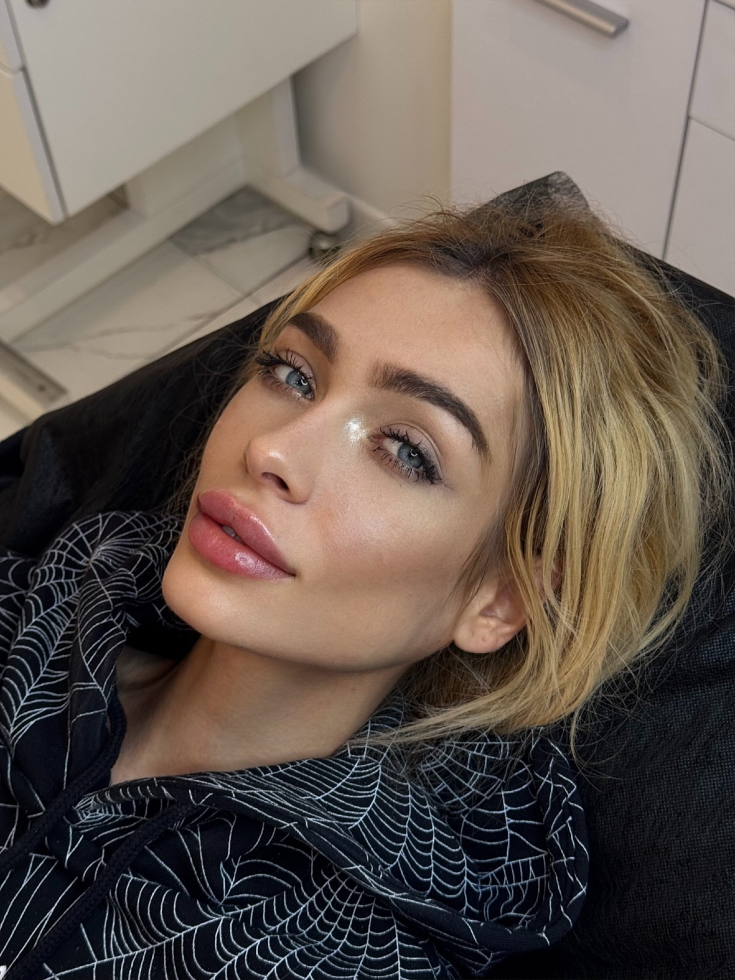 Збільшення губ, фото - Косметолог Ангелина