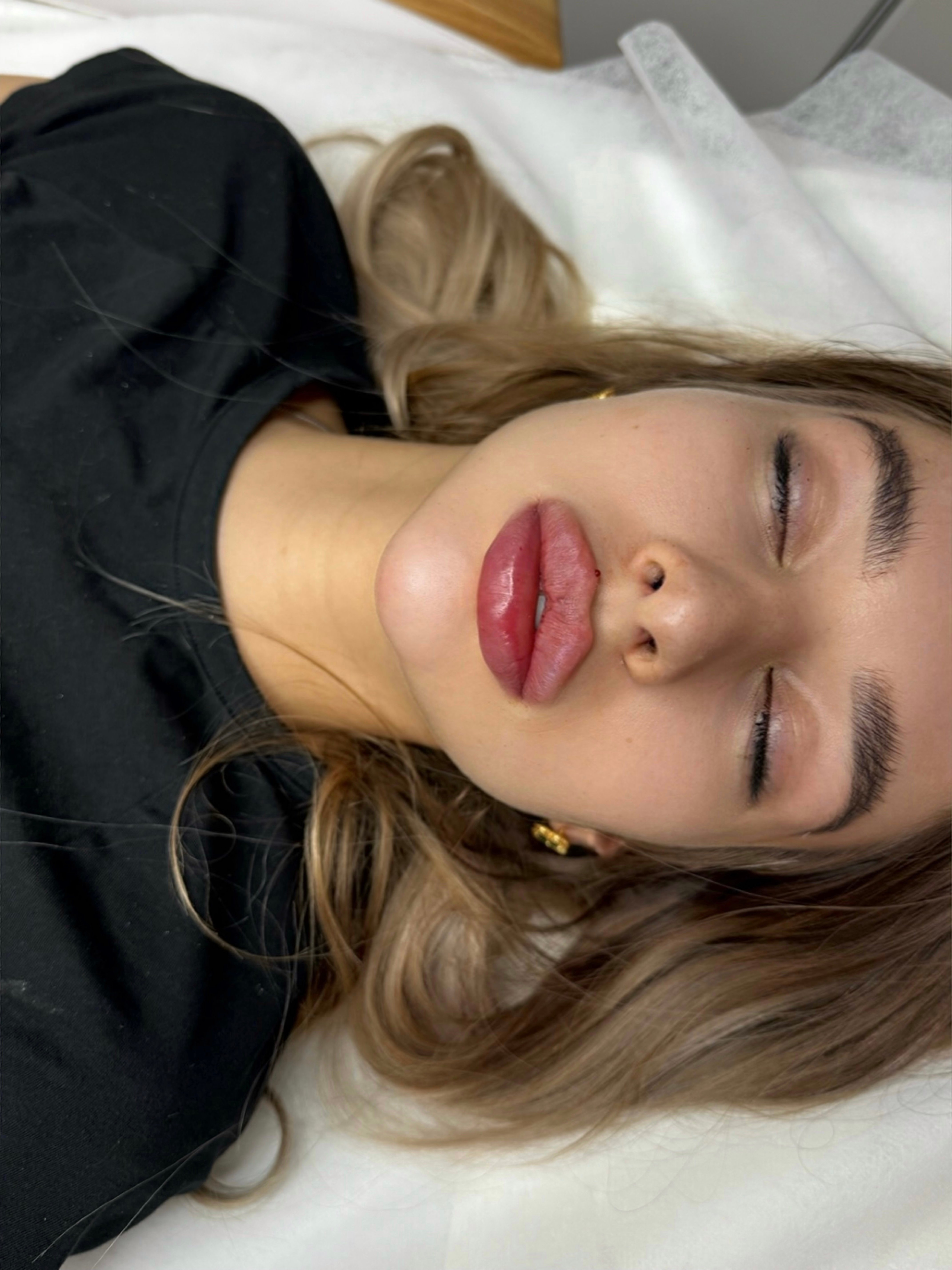 Збільшення губ, фото - Косметолог Ангелина