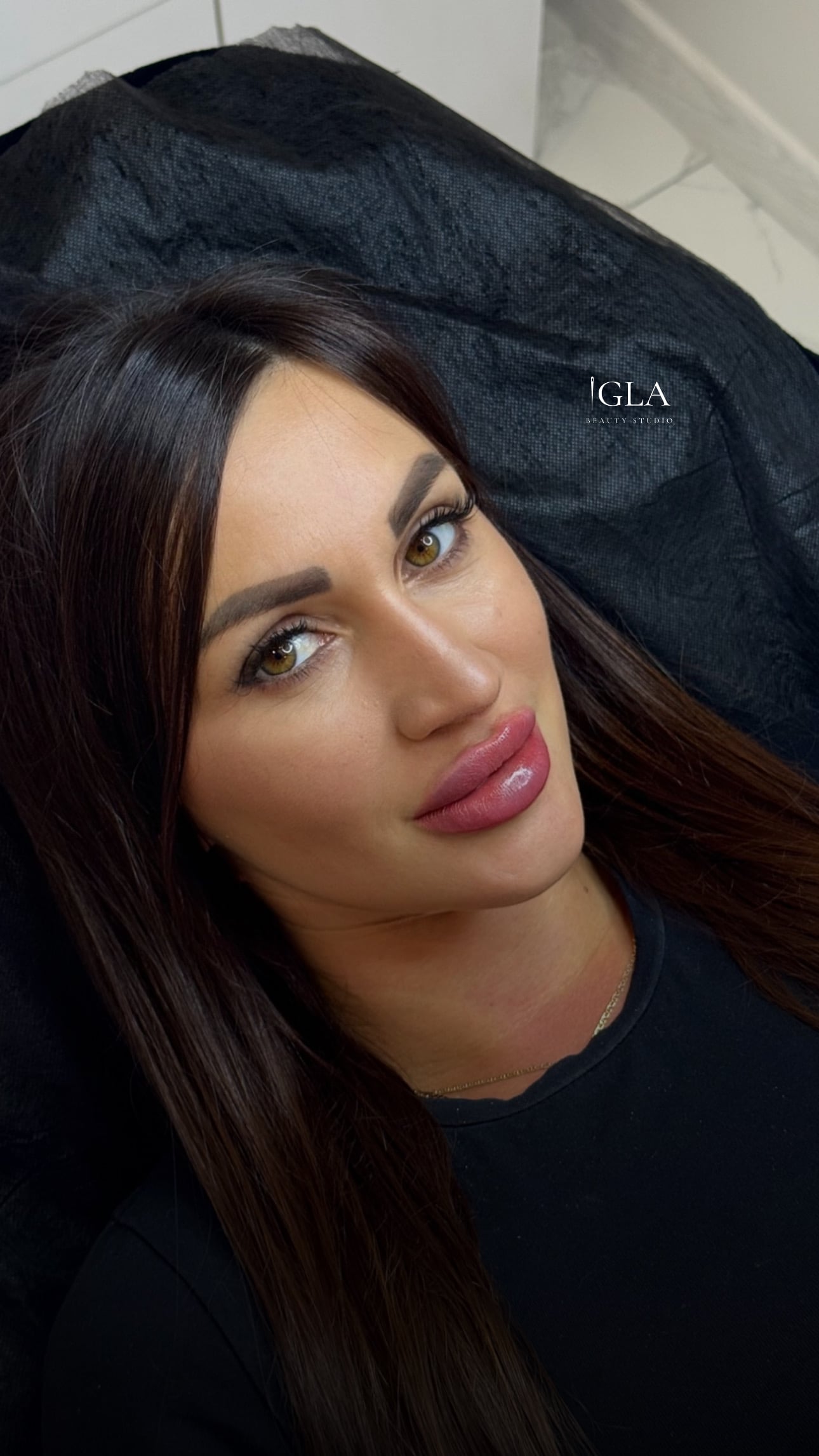 Збільшення губ, фото - Косметолог Ангелина