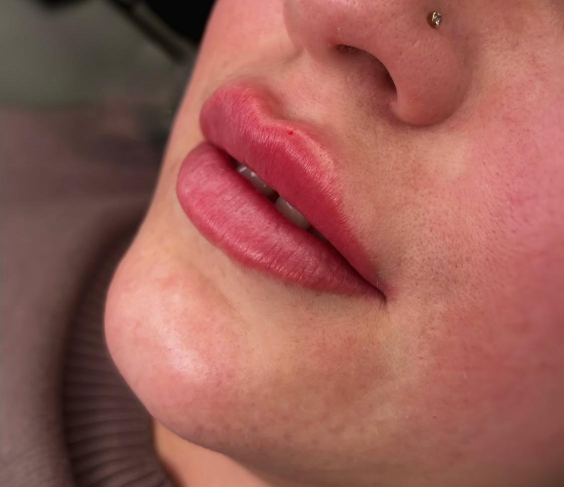 Контурна пластика губ (збульшення губ), фото - Косметолог Татьяна Гандзюк