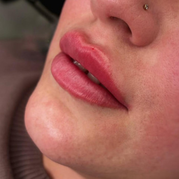 контурна пластика губ (збульшення губ)