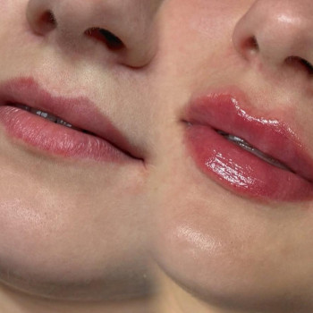 збільшення губ (контурна пластика)