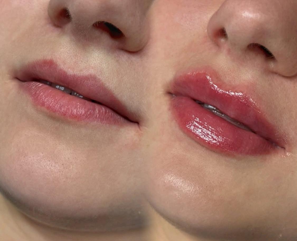 Збільшення губ (контурна пластика), фото - Косметолог Тетяна Гандзюк