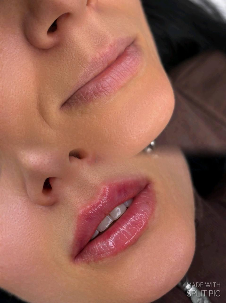 Контруна пластика губ (збільшення), фото - Косметолог Татьяна Гандзюк