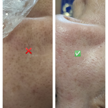 Механічна чистка обличчя