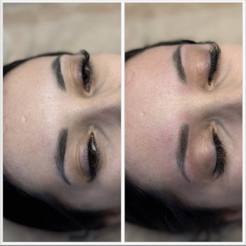 Одна процедура видалення лазером